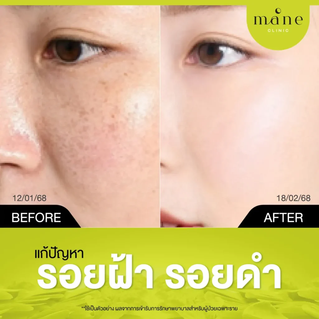 แก้ปัญหารอยฝ้า รอยดำ