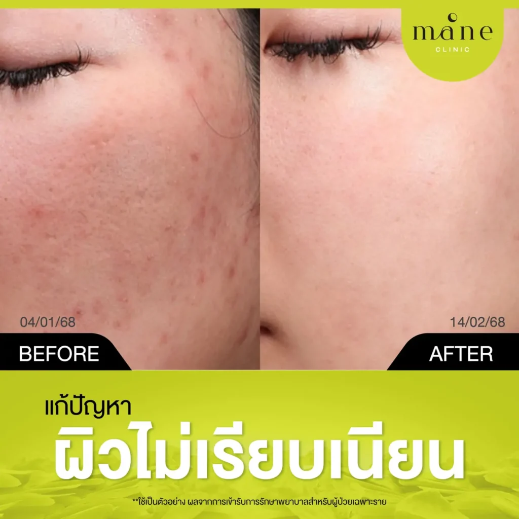 แก้ปัญหาผิวไม่เรียบเนียน