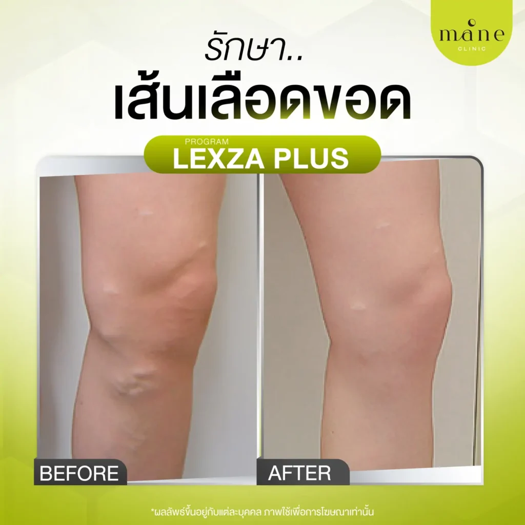 รีวิวรักษาเส้นเลือดขอด