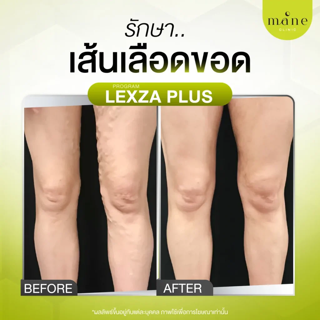 รีวิวรักษาเส้นเลือดขอด