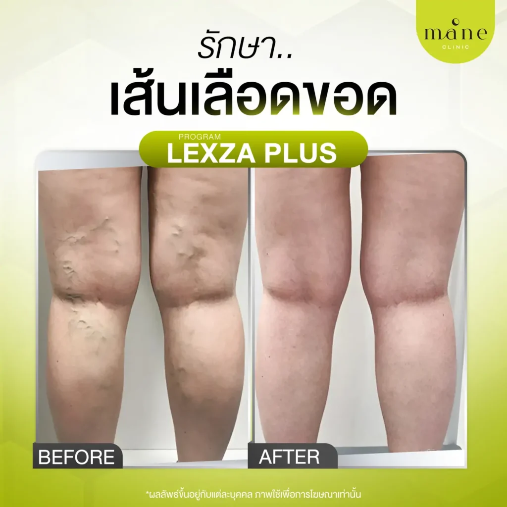 รีวิวรักษาเส้นเลือดขอด