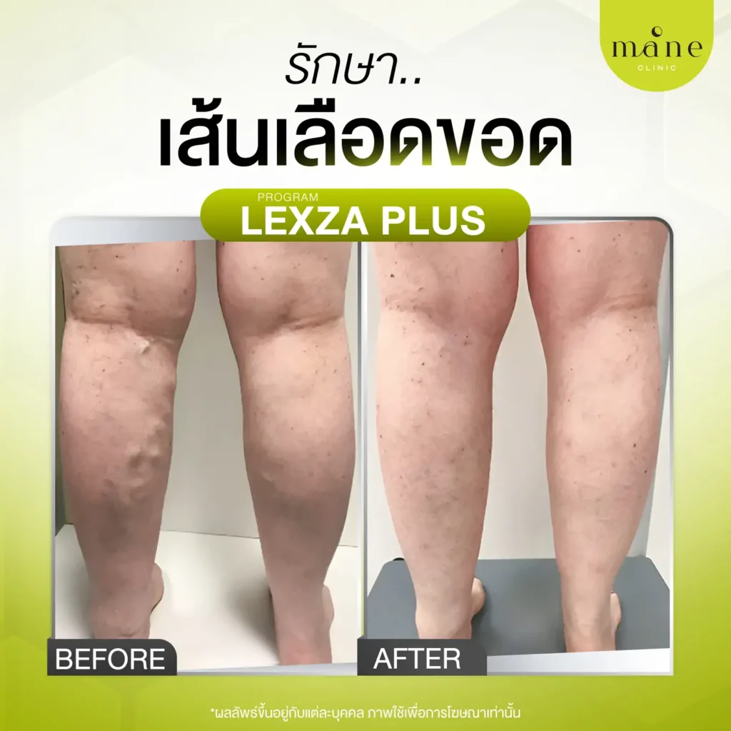 รีวิวรักษาเส้นเลือดขอด