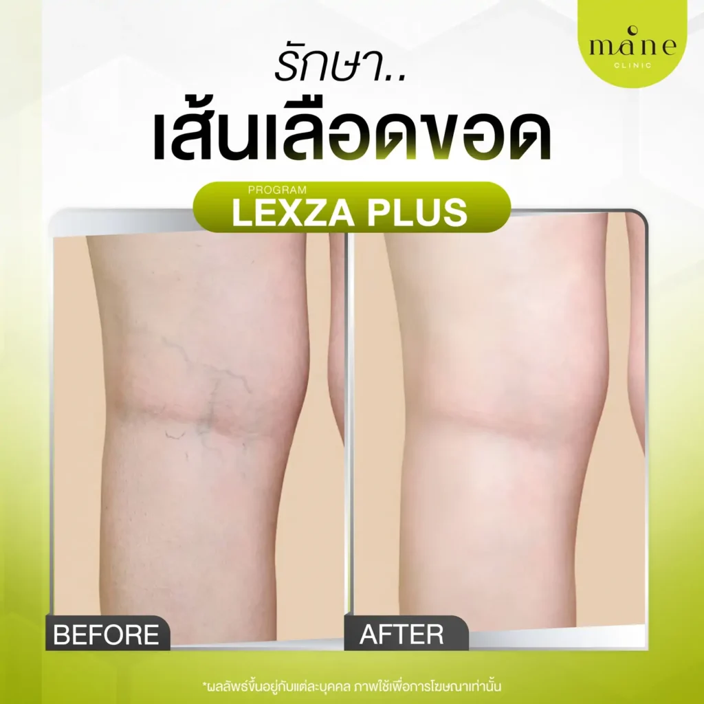 รีวิวรักษาเส้นเลือดขอด