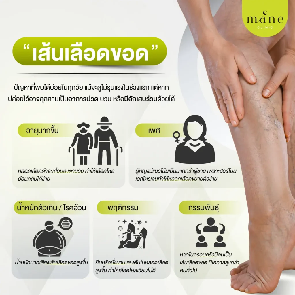 เส้นเลือดขอด