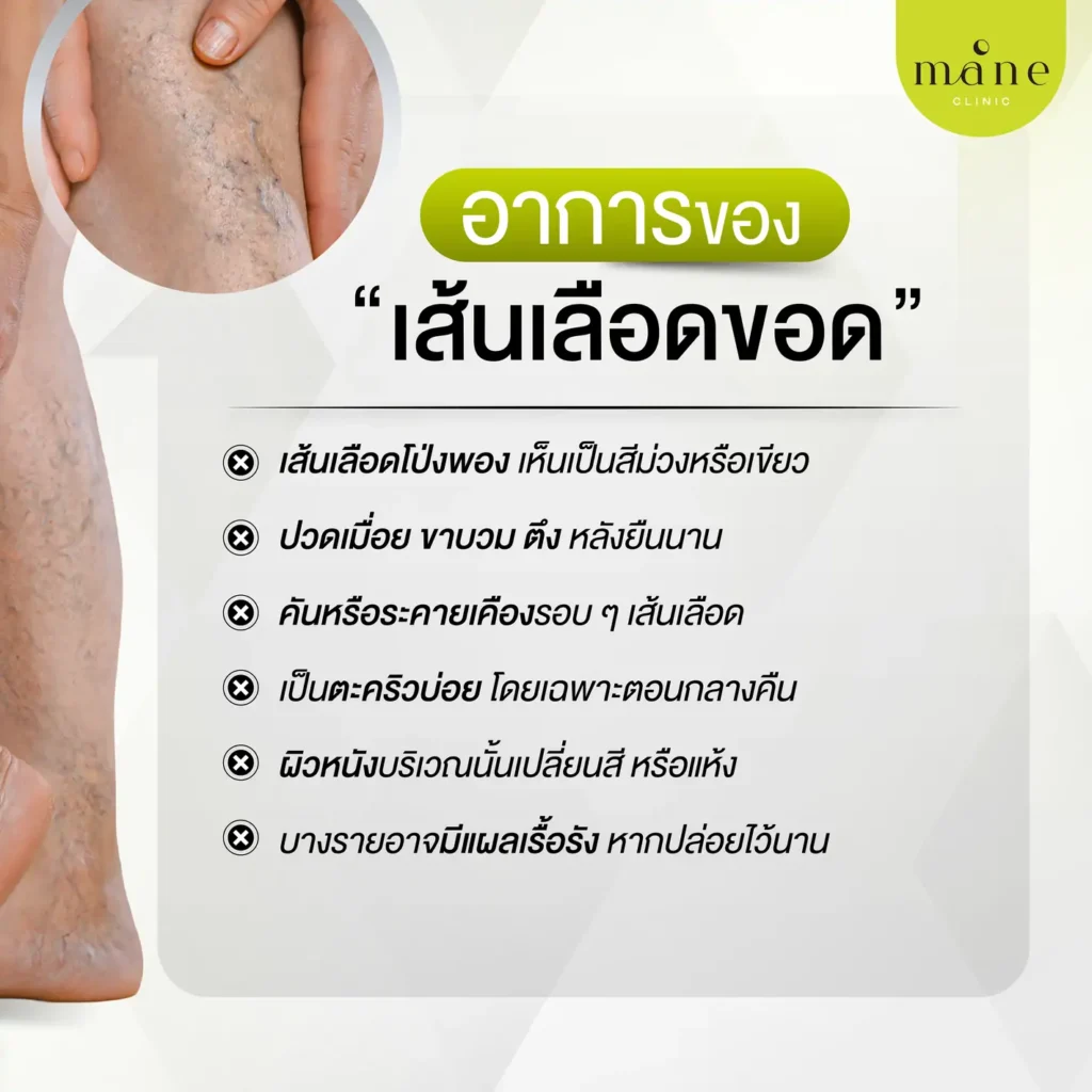 อาการของเส้นเลือดขอด