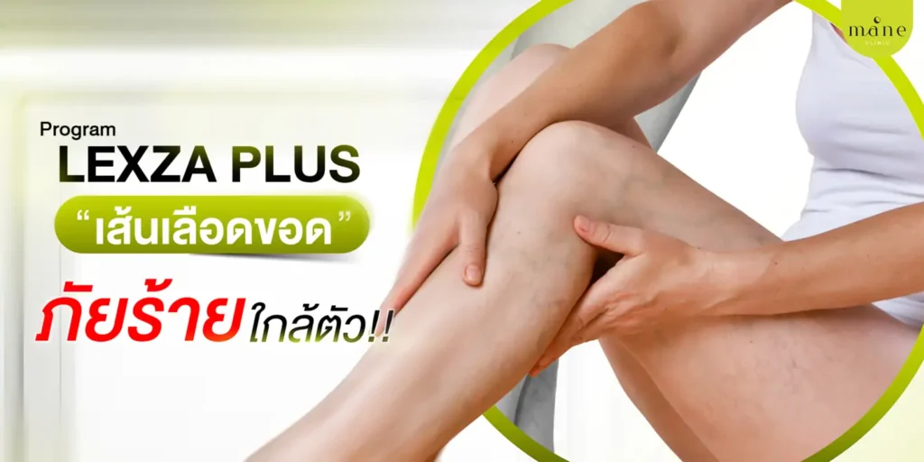 โปรแกรม Lexza Plus หมดปัญหาเส้นเลือดขอด กวนใจ สุขภาพขาเรียวสวย แบบไม่ต้องผ่าตัด