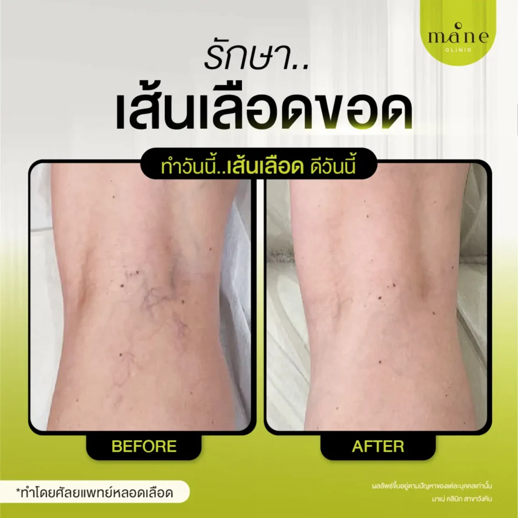 รีวิวรักษาเส้นเลือดขอด