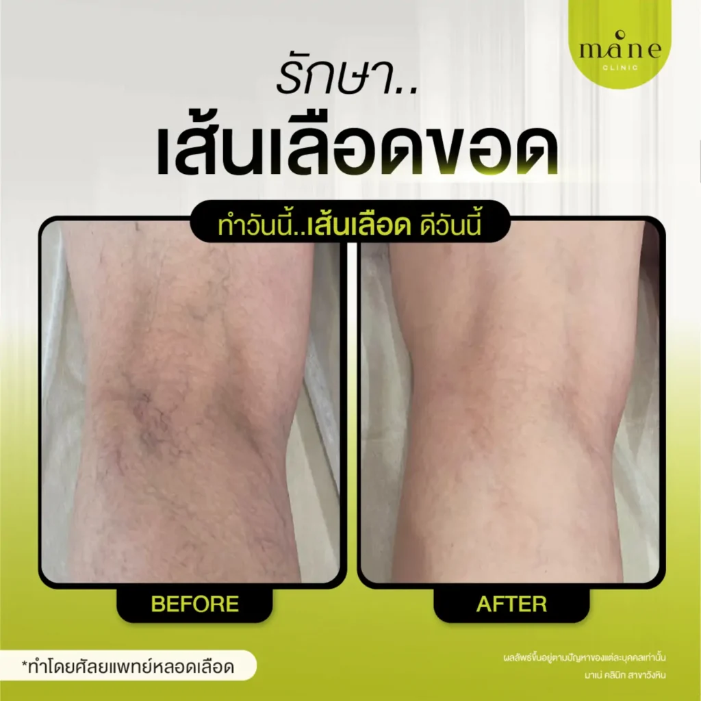 รีวิวรักษาเส้นเลือดขอด