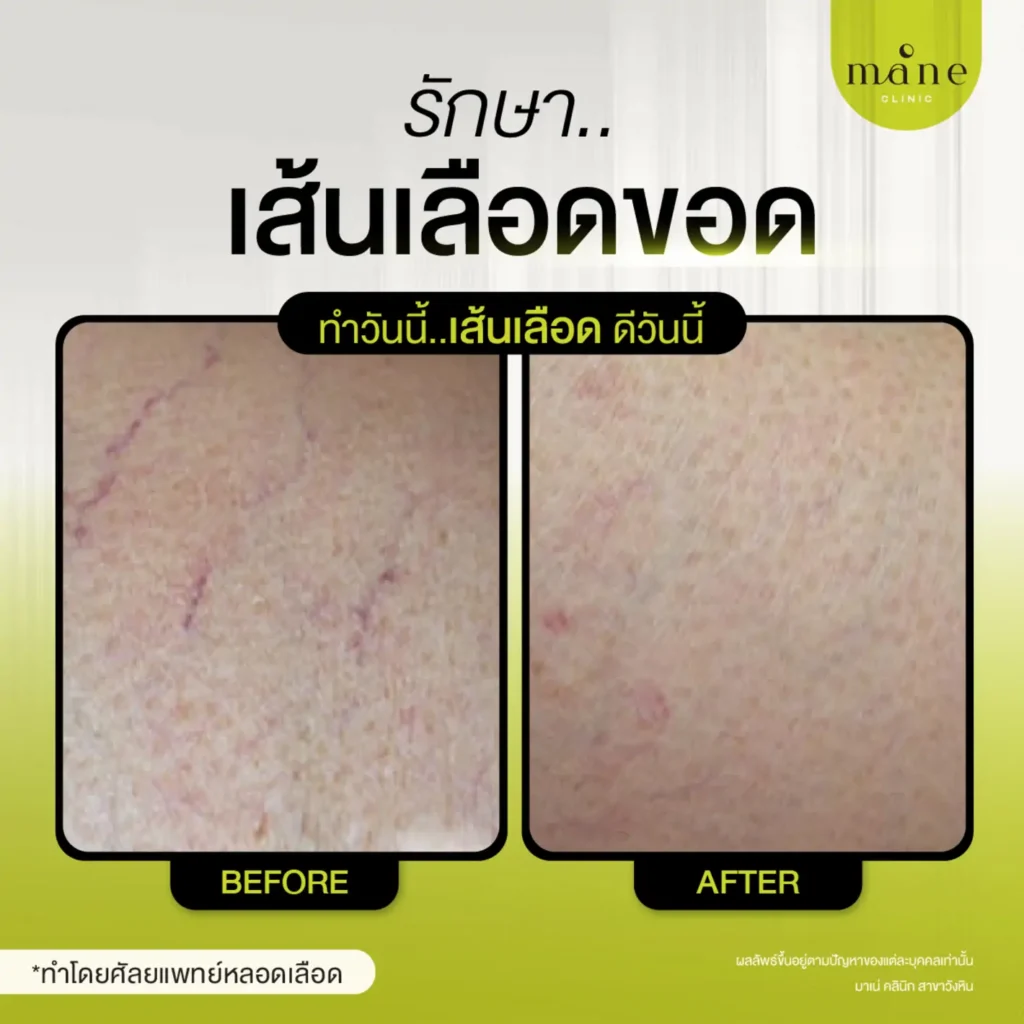 รีวิวรักษาเส้นเลือดขอด