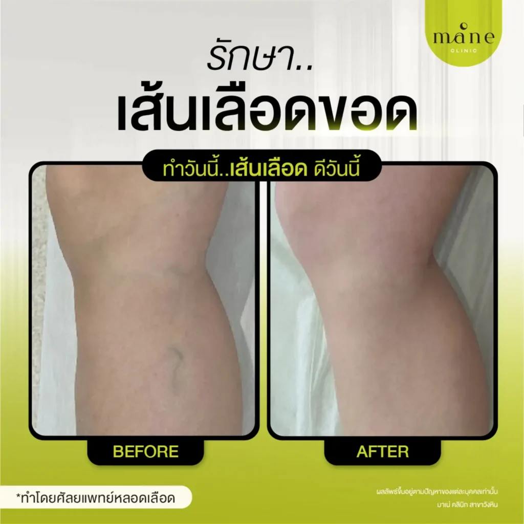 รีวิวรักษาเส้นเลือดขอด