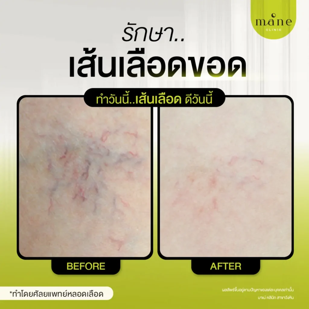 รีวิวรักษาเส้นเลือดขอด