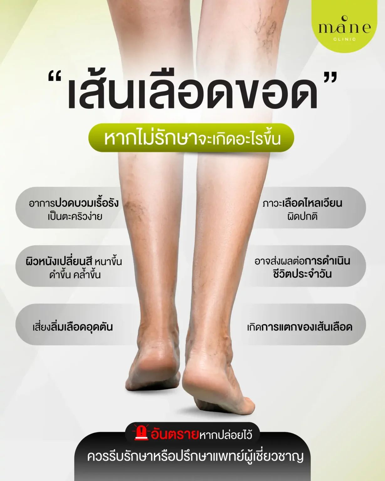 เส้นเลือดขอด หากไม่รักษาจะเกิดอะไรขึ้น