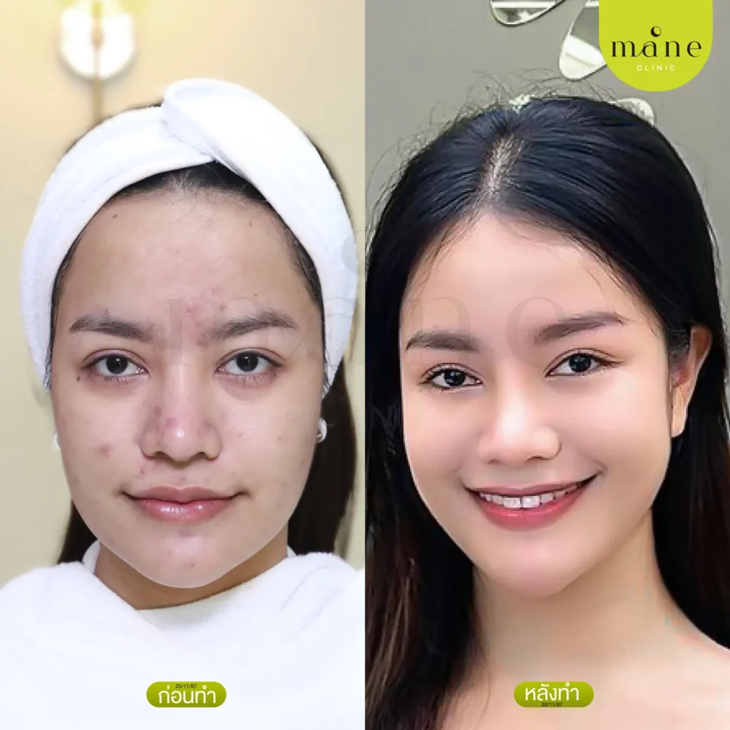 ก่อน-หลัง