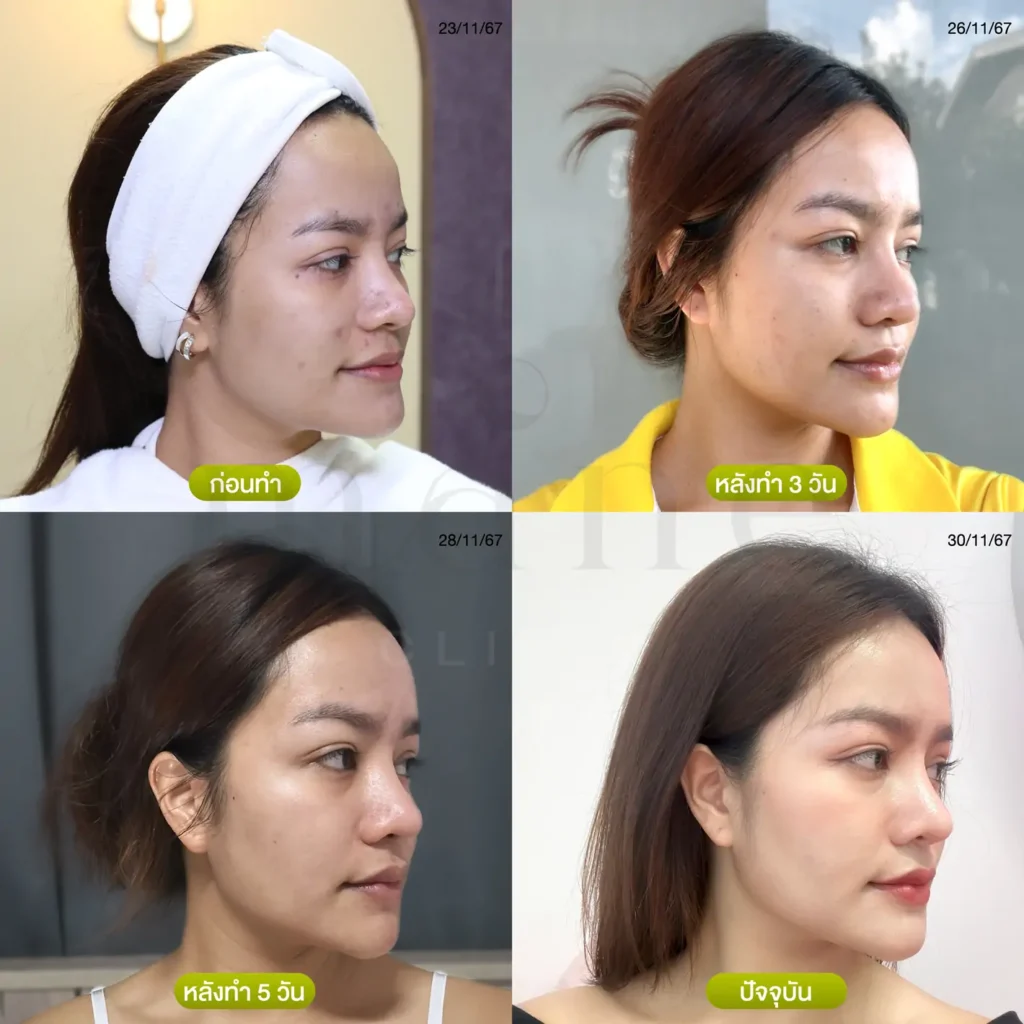 ก่อน-หลัง