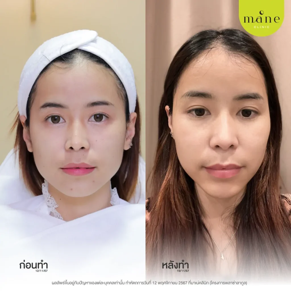 ก่อนทำ-หลังทำ