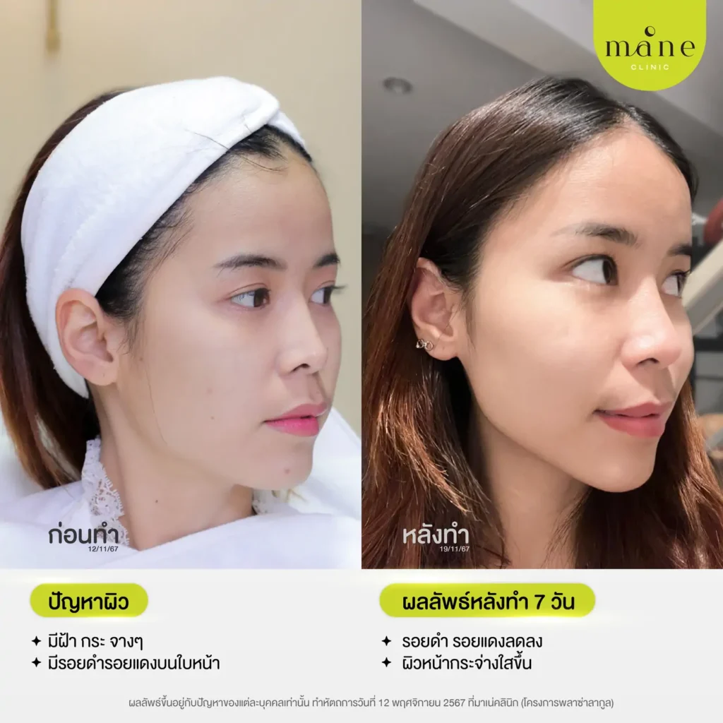 ก่อนทำ-หลังทำ