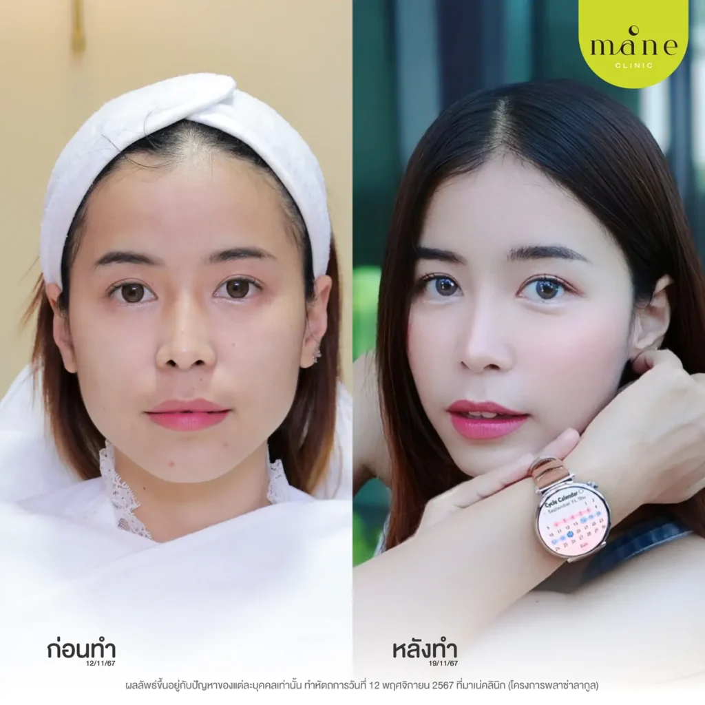 ก่อนทำ-หลังทำ