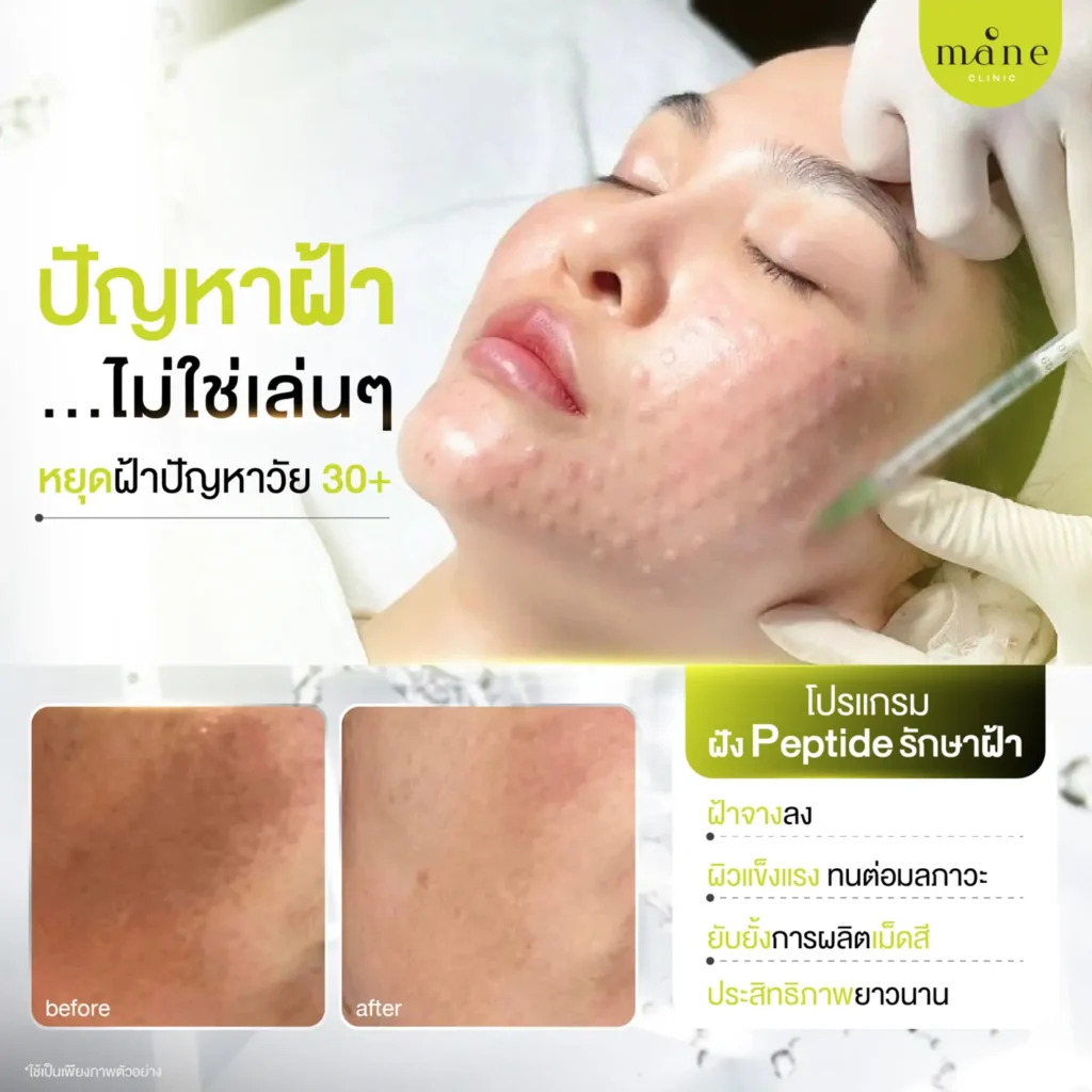 ปัญหาฝ้า ไม่ใช่เล่นๆ