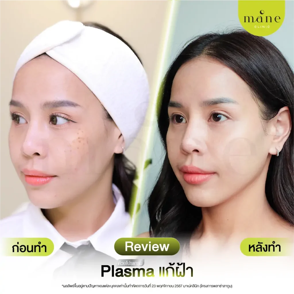ก่อนทำ-หลังทำ