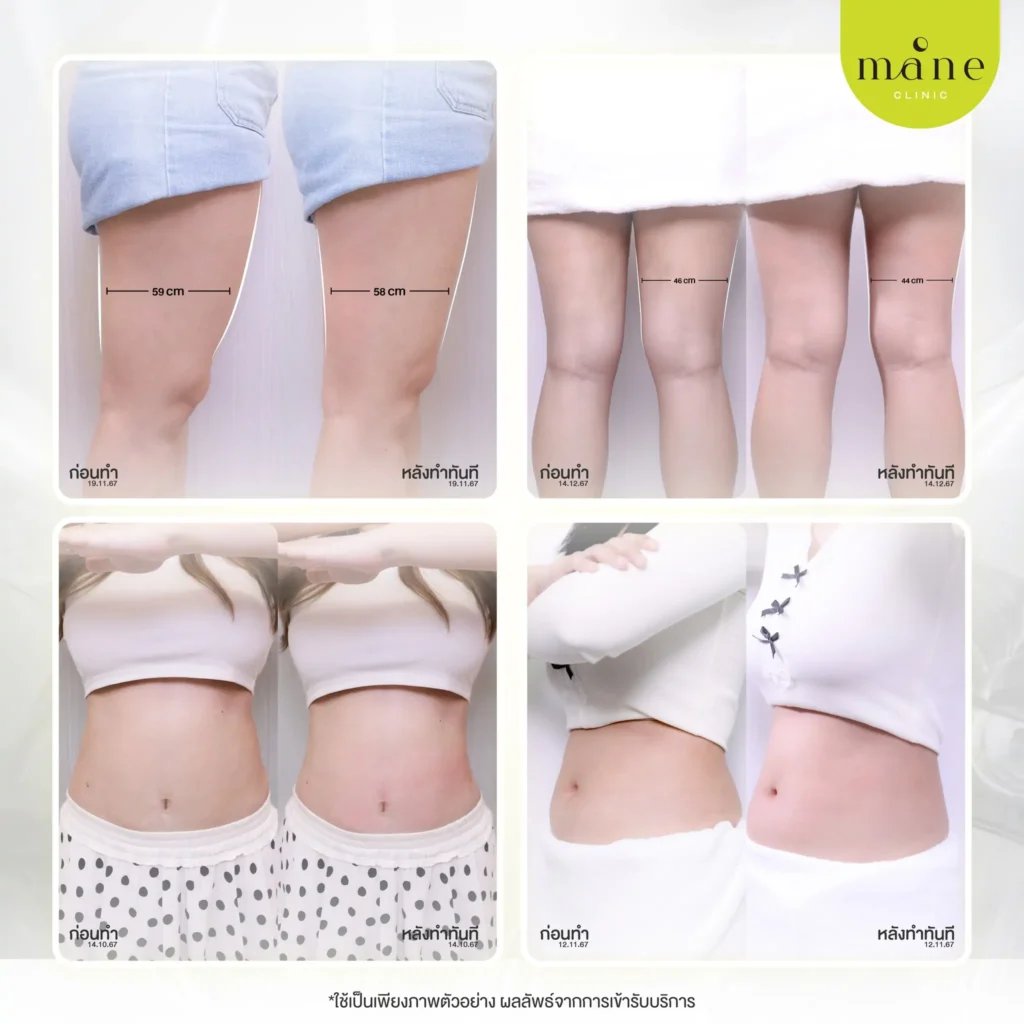 Before–After