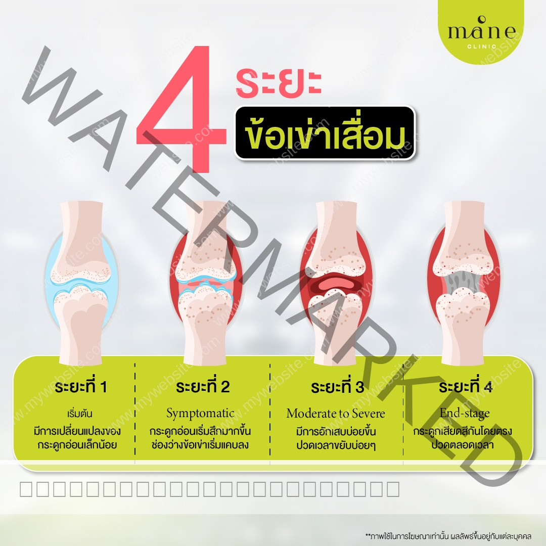 4 ระยะ ข้อเข่าเสื่อม
