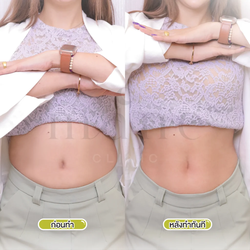 Before–After