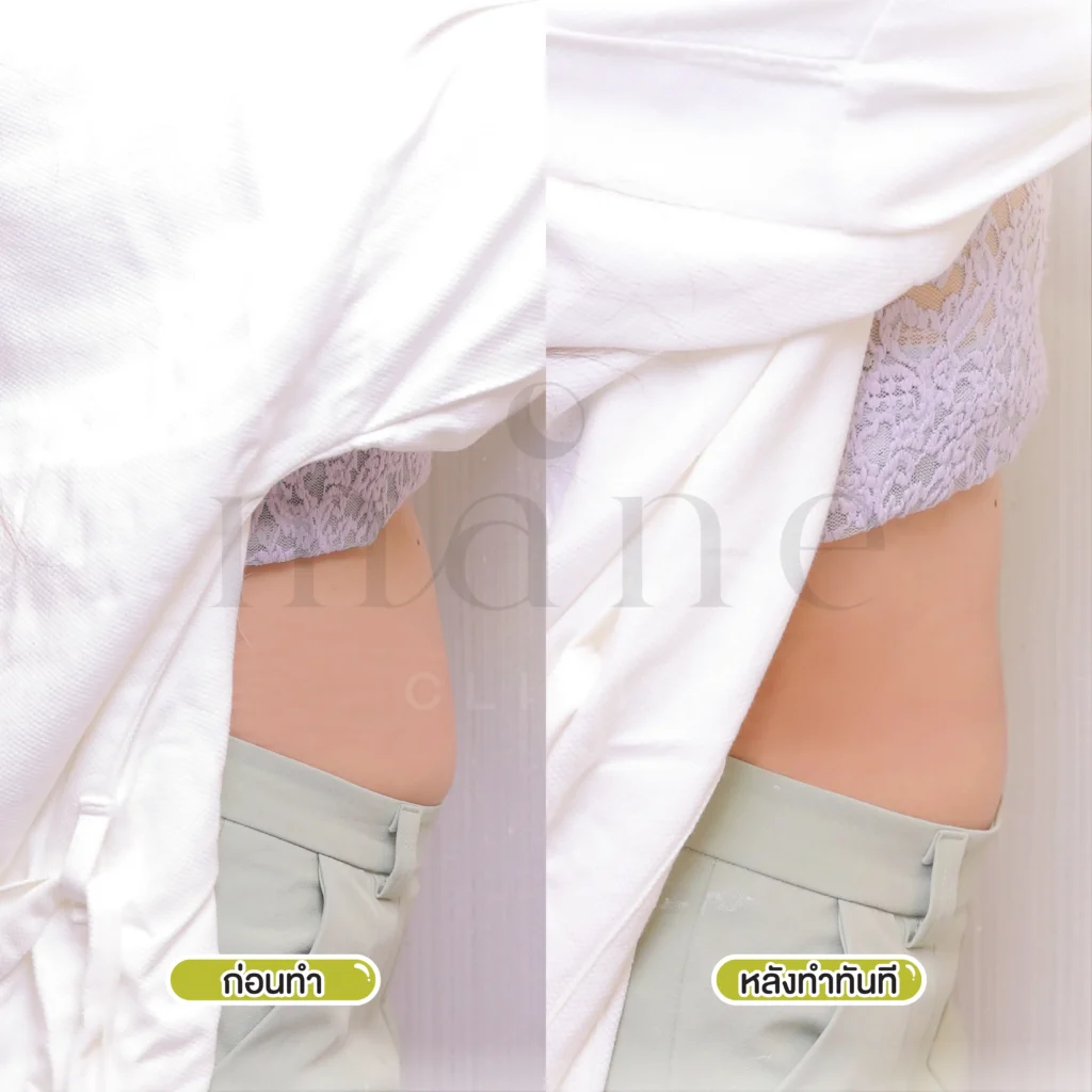 Before–After