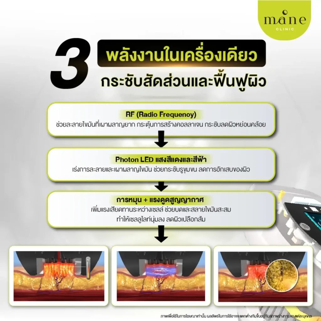 Program Body Sculpting คืออะไร