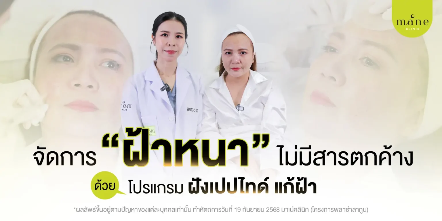 จัดการฝ้าหนา โปรแกรมฝังแปปไทด์ แก้ฝ้า