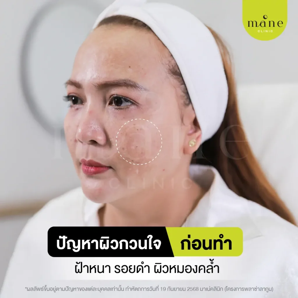 ปัญหาฝ้าที่หนักขึ้นจากการทำเลเซอร์