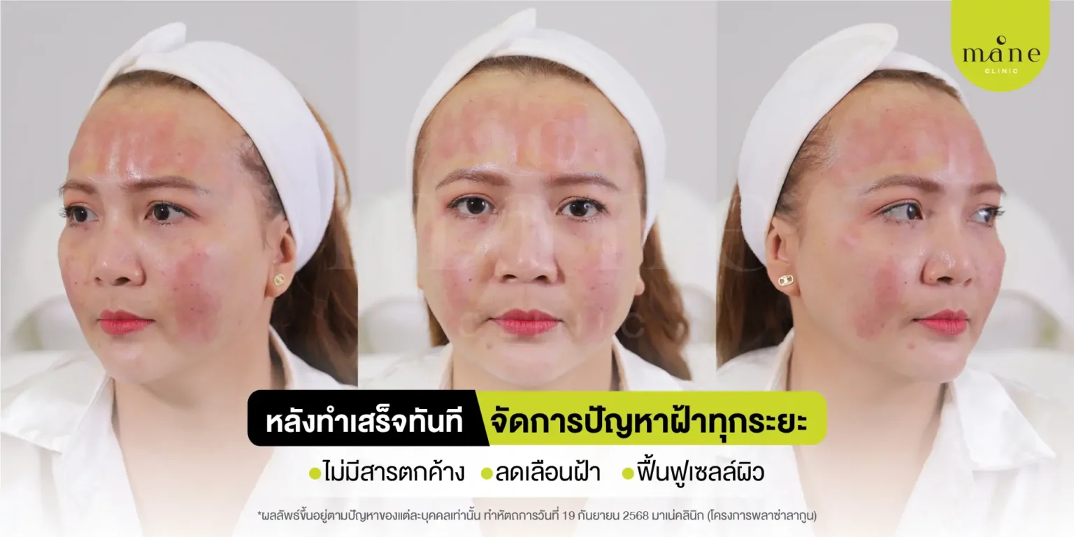 หลังทำเสร็จทันที