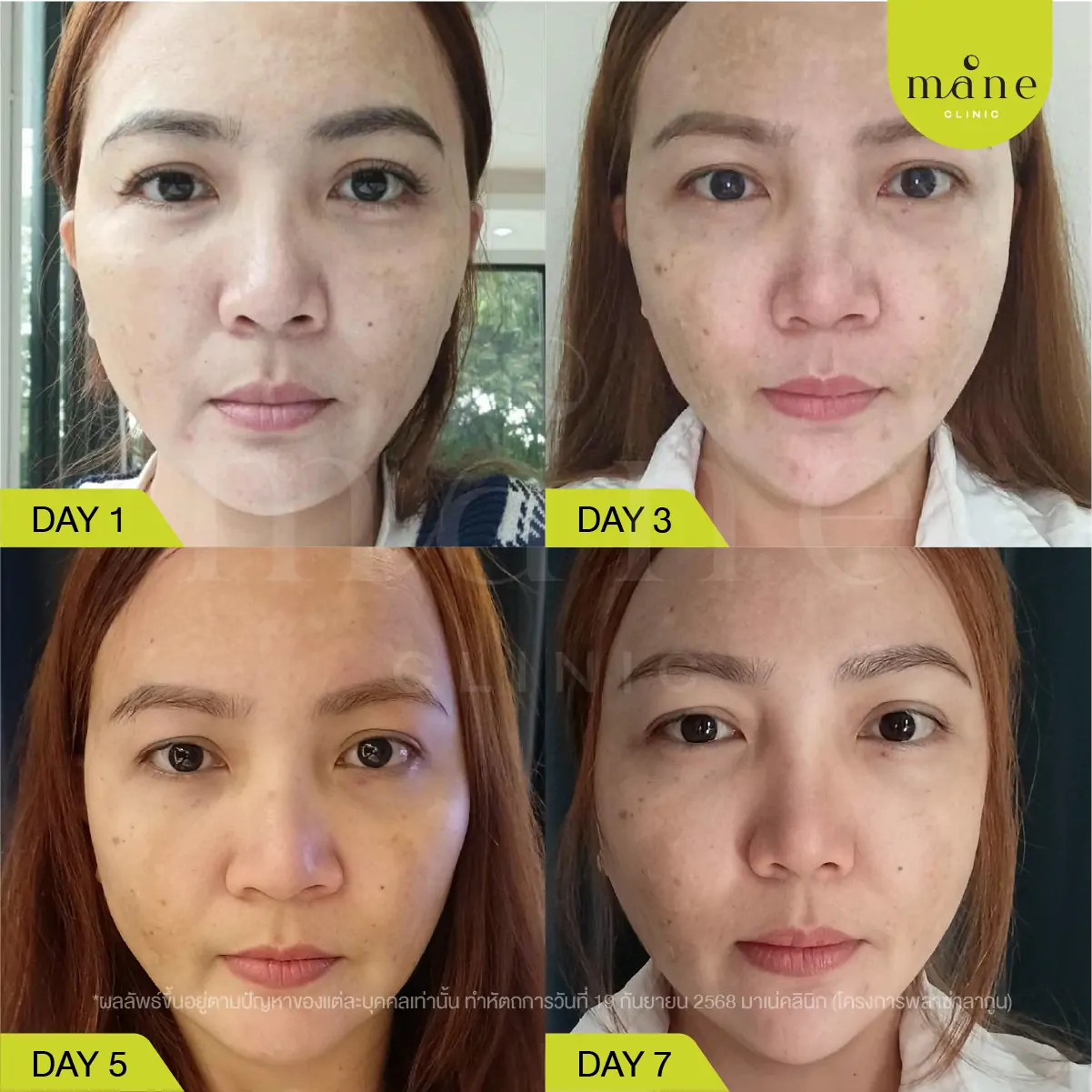 ผ่านไปประมาณ 2–3 สัปดาห์