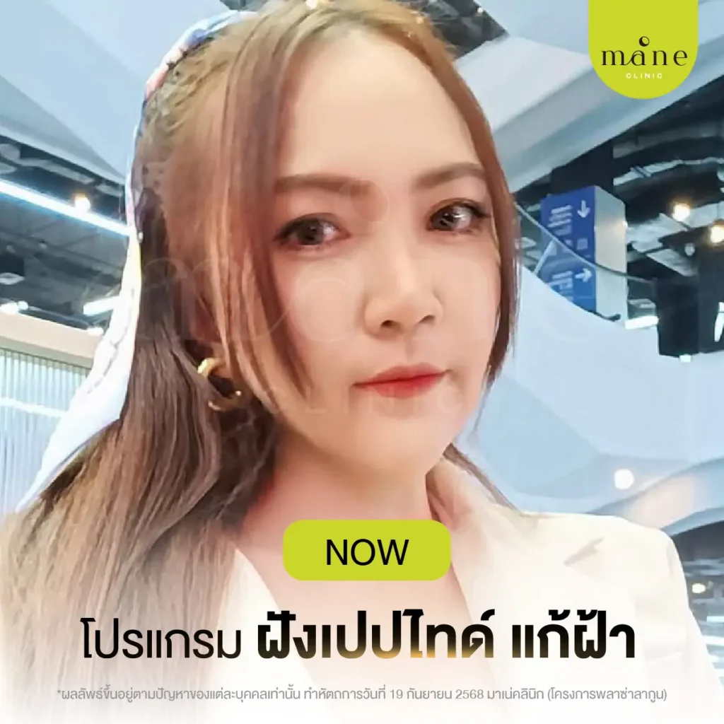 โปรแกรมฝังเปปไทด์แก้ฝ้า