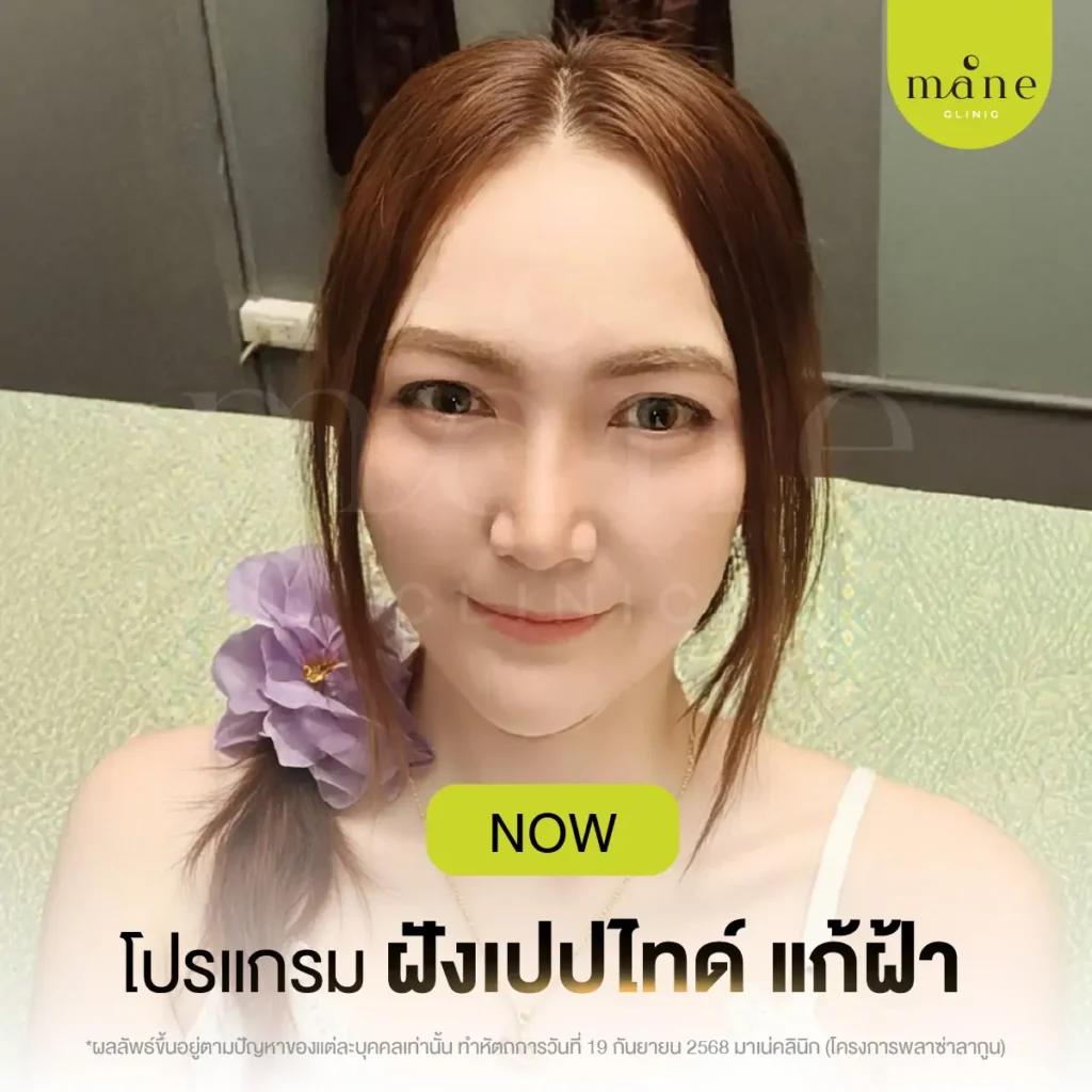 โปรแกรมฝังเปปไทด์แก้ฝ้า