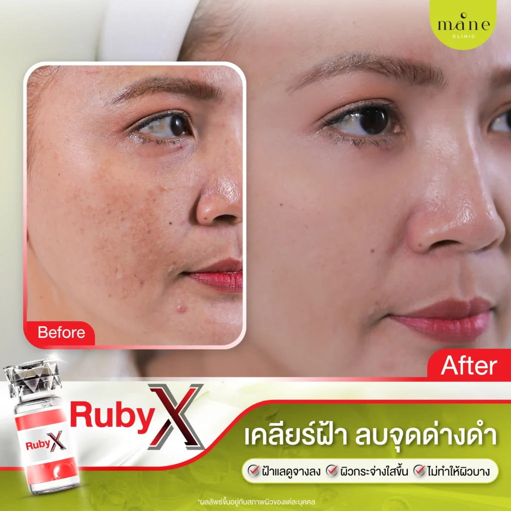 ผลลัพธ์หลังทำ