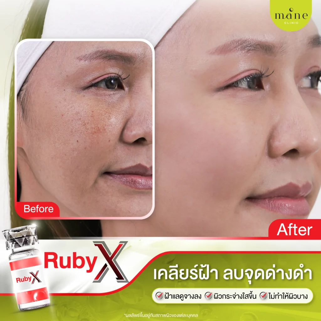 ผลลัพธ์หลังทำ