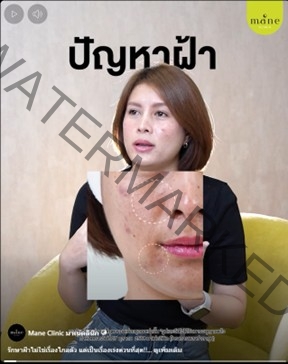 ปัญหาฝ้า