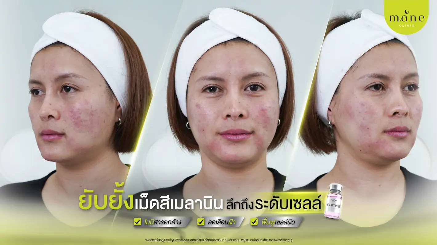 ยับยั้งเม็ดสีเมลานินลึกถึงระดับเซลล์