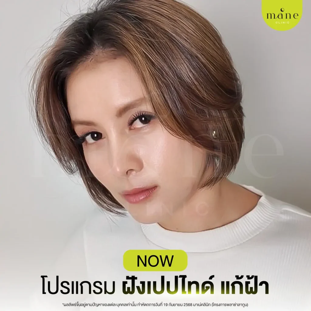 โปรแกรมฝังเปปไทด์ แก้ฝ้า