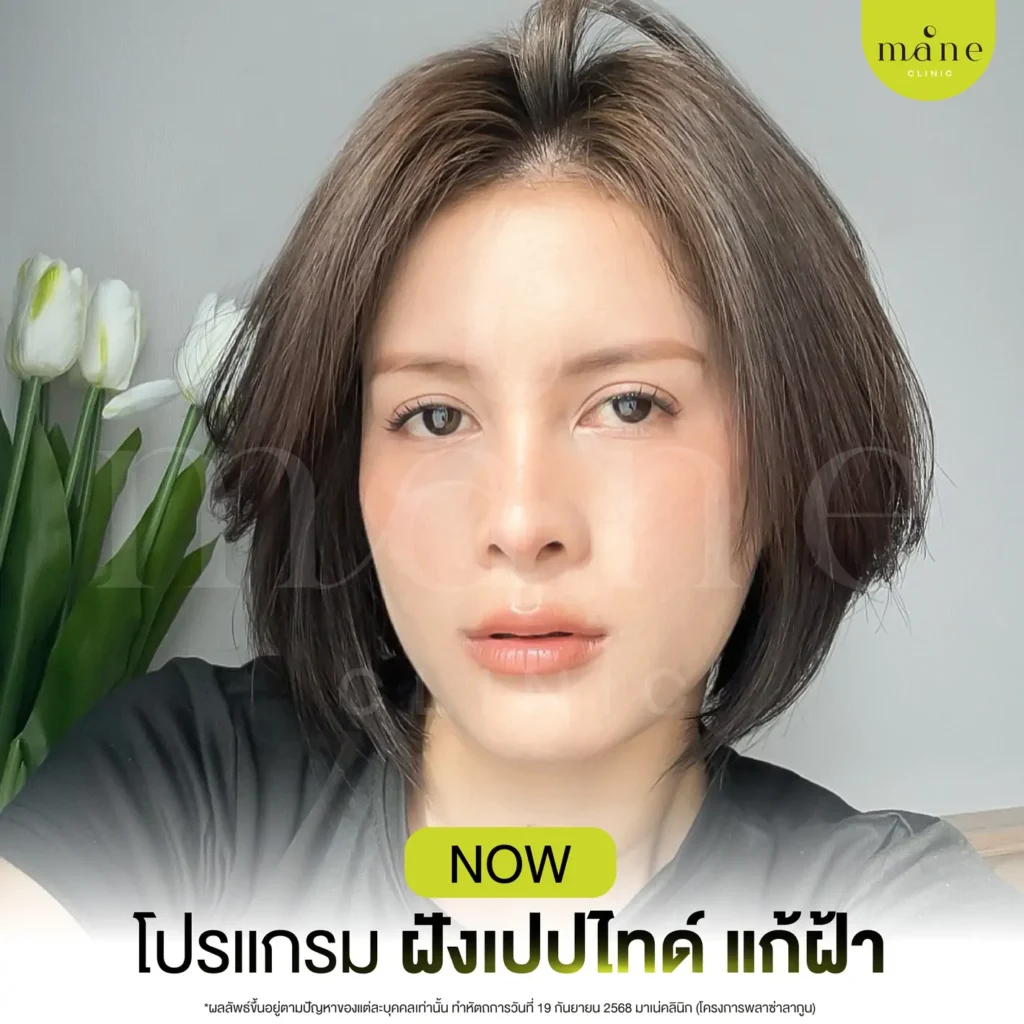 โปรแกรมฝังเปปไทด์ แก้ฝ้า