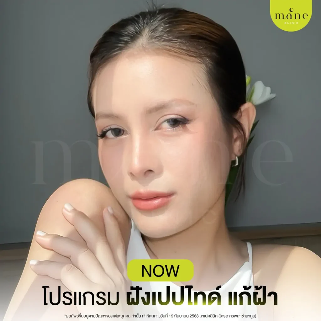 โปรแกรมฝังเปปไทด์ แก้ฝ้า