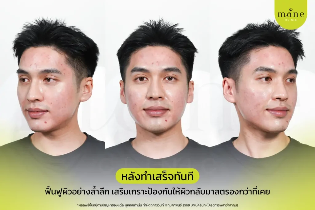 หลังทำเสร็จทันที