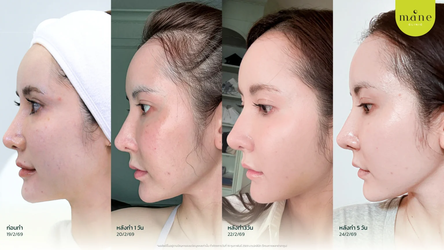 หลังทำทันที