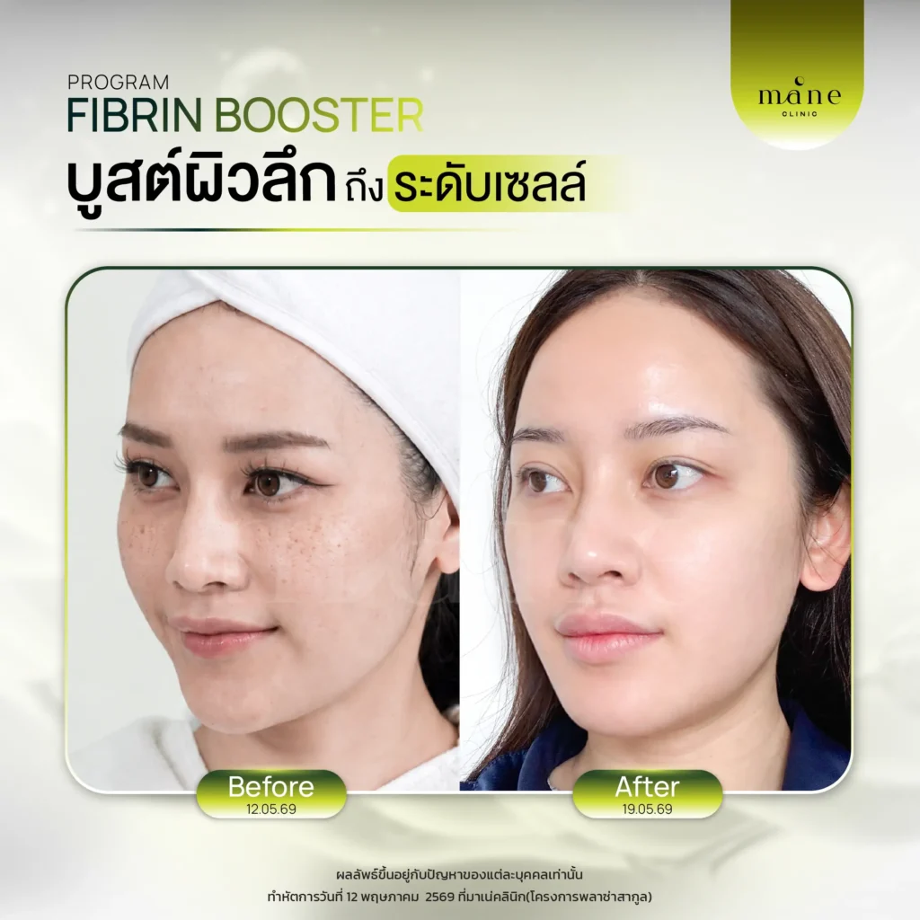 ผลลัพธ์หลังทำ Fibrin Booster