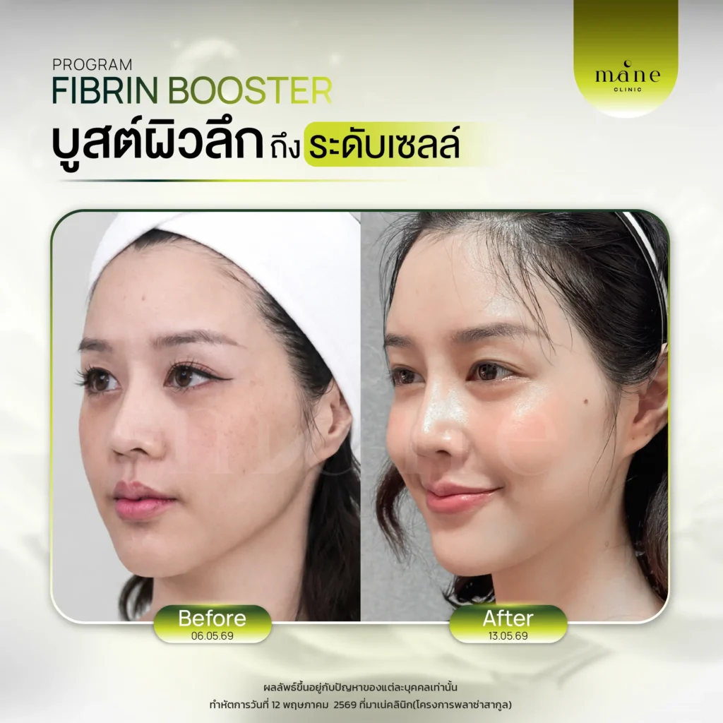 ผลลัพธ์หลังทำ Fibrin Booster