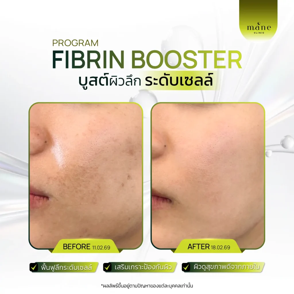 โปรแกรม Fibrin Booster
