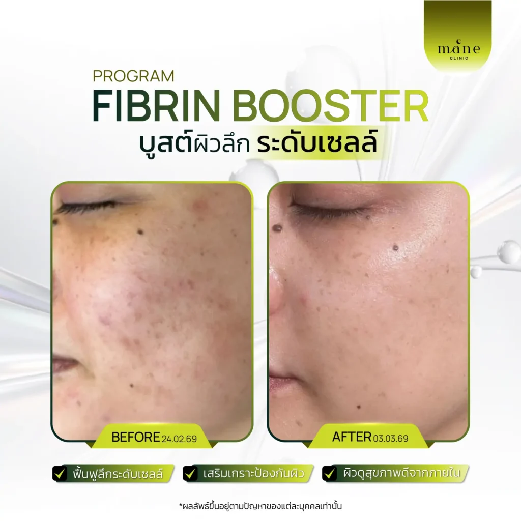 โปรแกรม Fibrin Booster