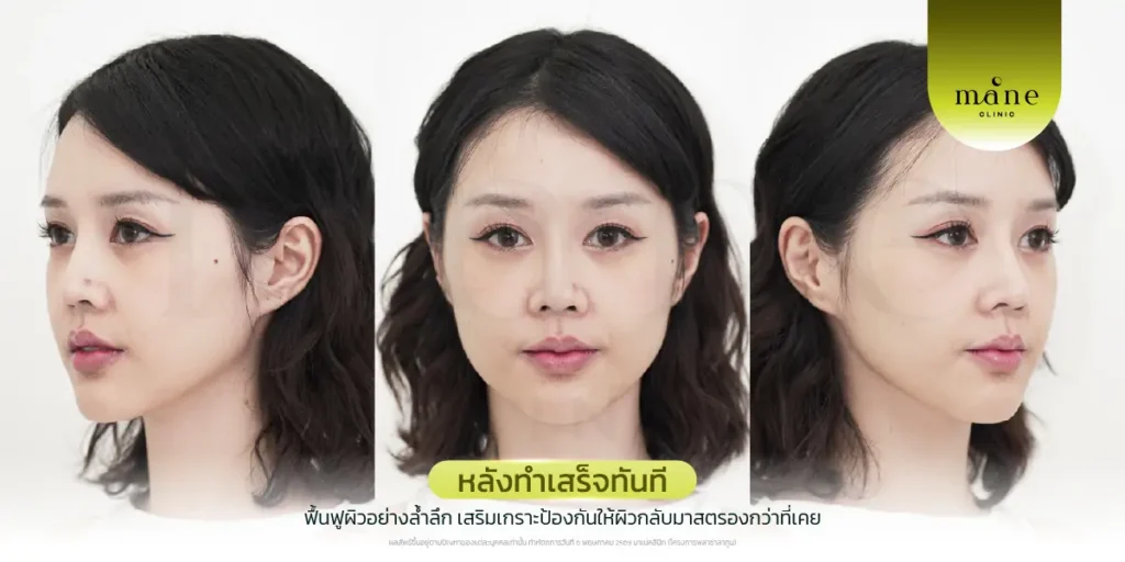 หลังทำทันทีจะรู้สึกว่าผิวดูฟูขึ้น