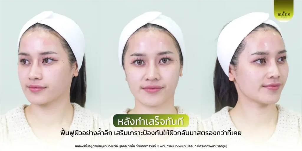 หลังทำเสร็จทันที