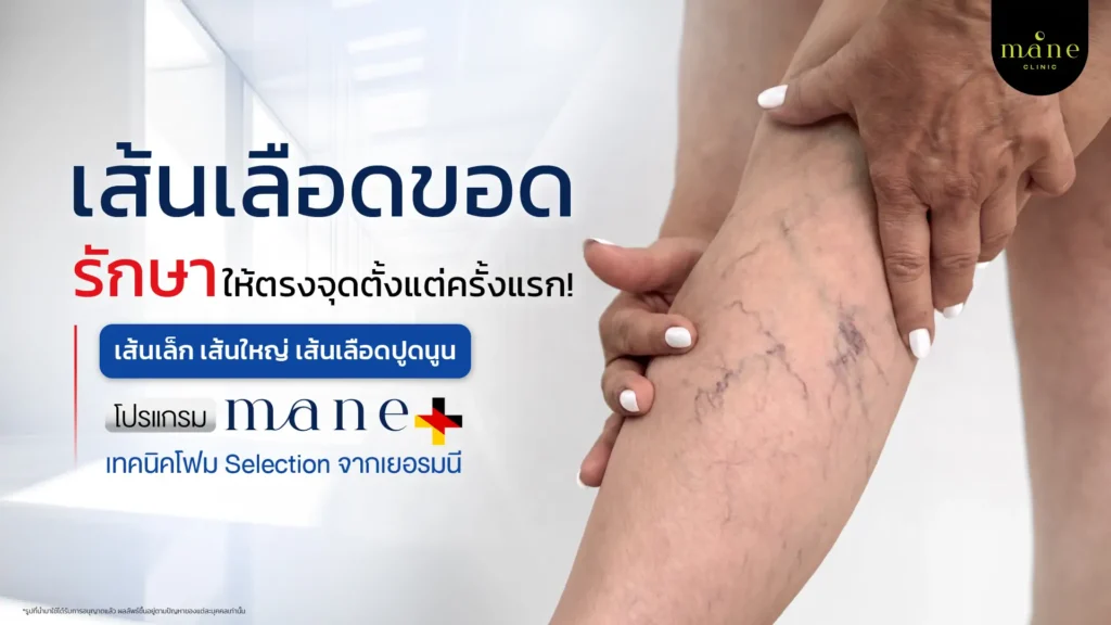 เส้นเลือดขอด รักษาให้ตรงจุด